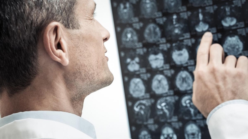 Aneurisma cerebral: ¿de qué se trata esta patología?